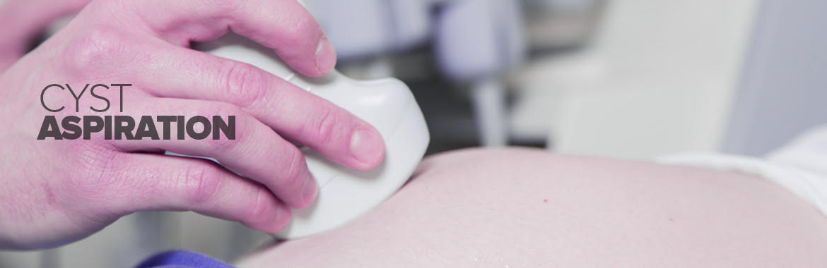 Cyst Aspiration
